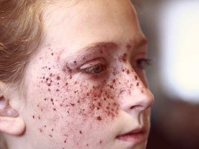 Portrait of a girl with a lot of freckle-like birth marks