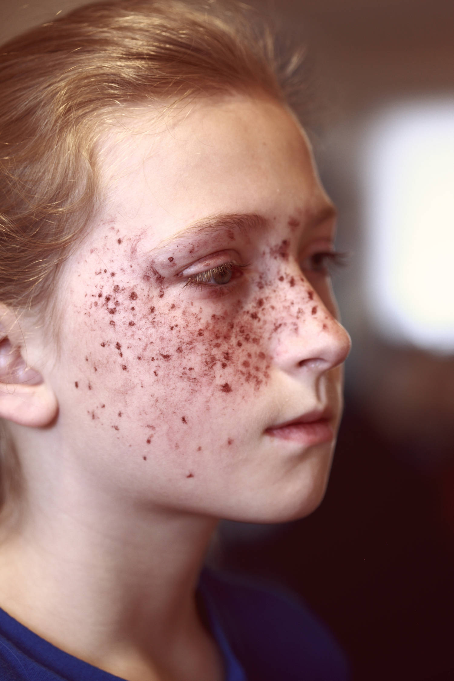 Portrait of a girl with lots of red marks (birth marks?) on her face